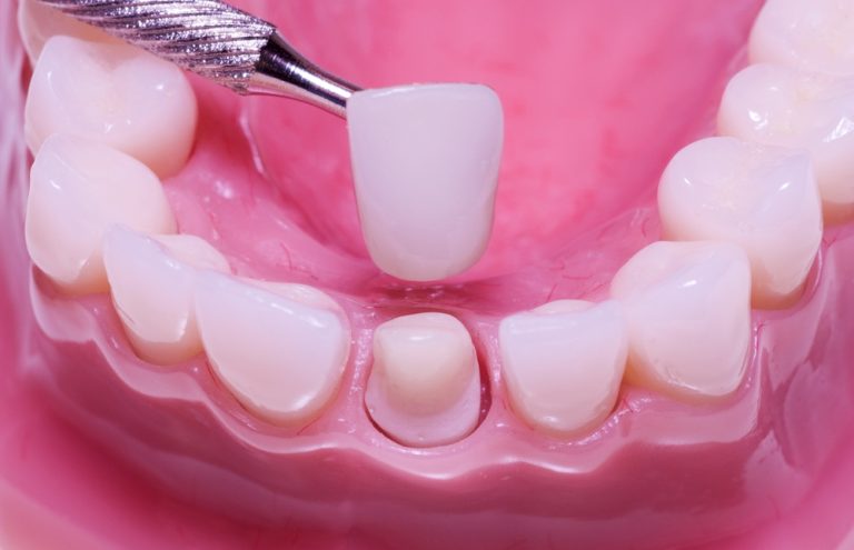 Dental Crowns for Tooth Replacement & Cosmetic Purposes in Norwalk CA