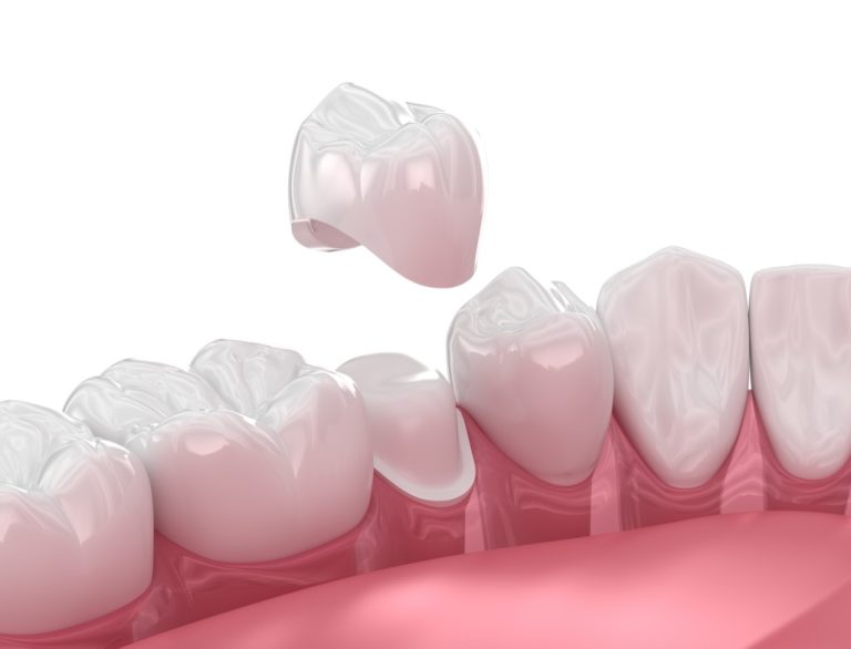 Dental Crowns Near Me in Norwalk