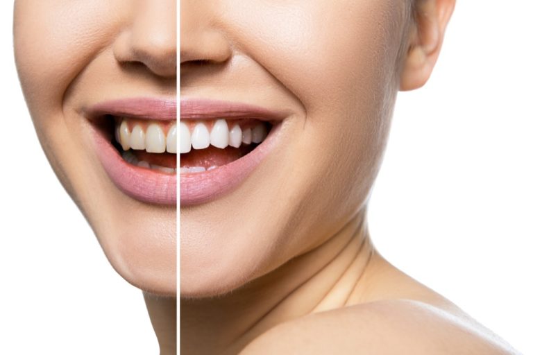 Teeth Whitening Treatment in Norwalk