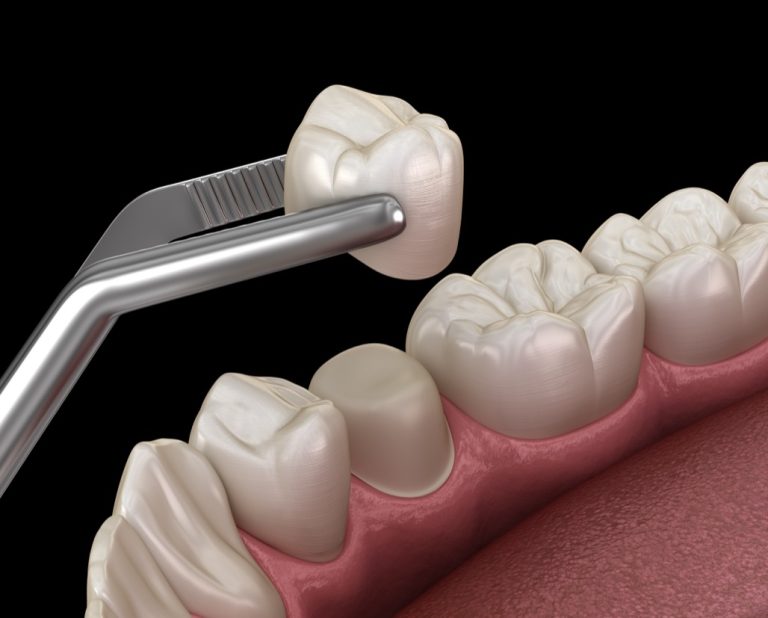 Dental Crowns Near Me in Norwalk