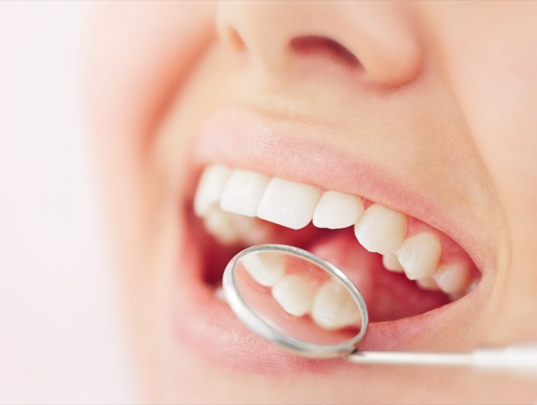 Dental Crowns or Cavity Fillings Treatment Near Me in Norwalk