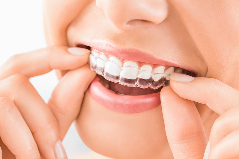 Clear Aligner Therapy in Norwalk