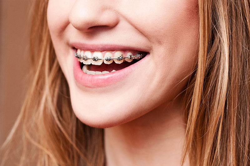 Metal Braces in Norwalk